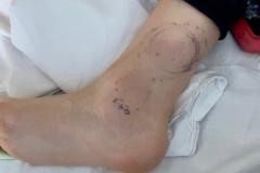 Dad's warning after 8-year-old son bitten by snake in local park